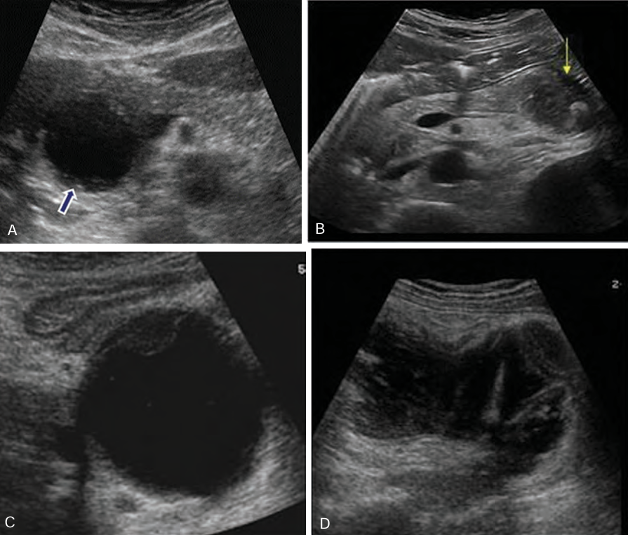 <p>Borders of pseudocysts are very _______, and they usually are _____ than other simple cysts. ________ may develop _____ the walls of the pseudocyst</p>