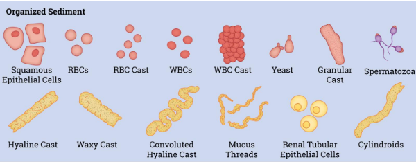 <p><span>cellular in origin and consists of many epithelial cells, casts, erythrocytes, leukocytes, or hyaline tissue. A cast forms when a renal tubule is temporarily plugged with cells and mucus</span></p>