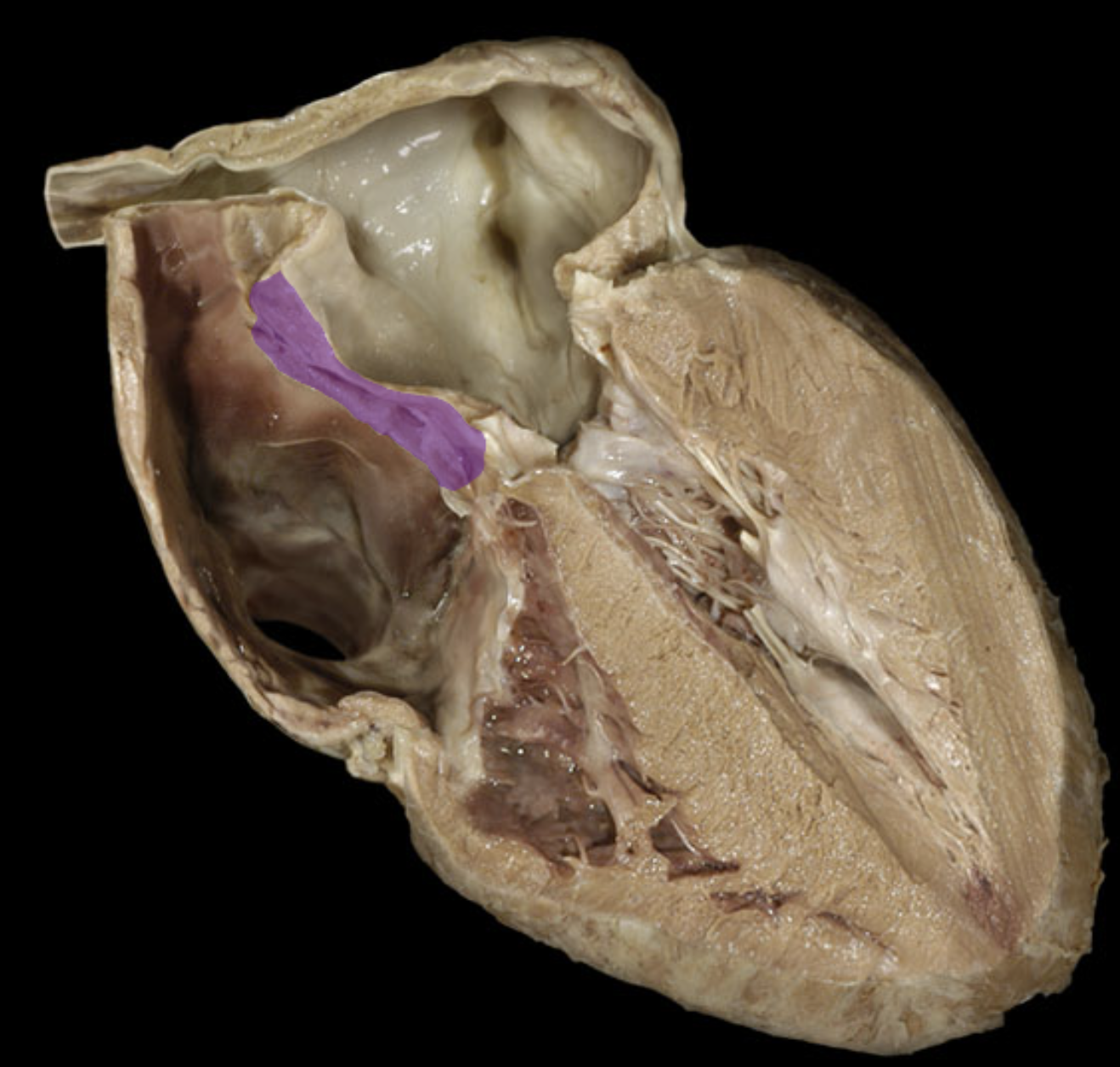 <p>Interatrial septum</p>