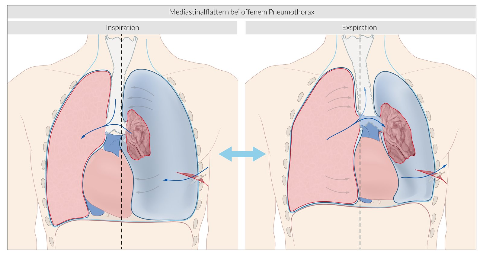 <p>C. Increase in perfusion of the right lung</p>