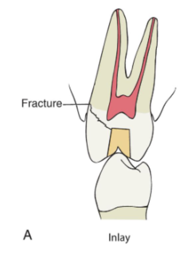<p>inlays can act as a wedge during cementation or funx, but if cusps are weakened → fx will occur&nbsp;</p>