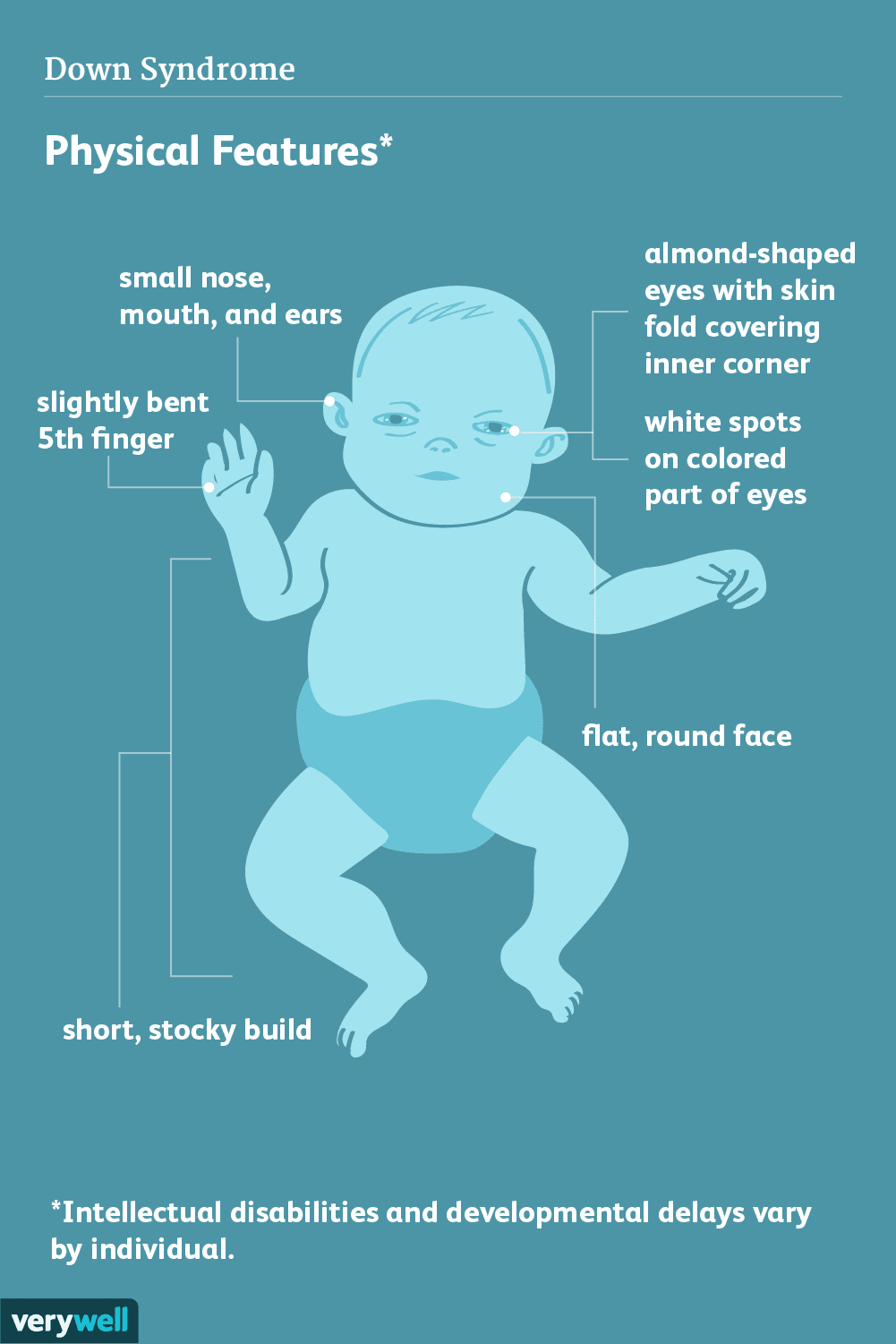 <p><strong>trisomy 21 </strong>→ congenital condition characterized by moderate-to-severe intellectual and physical disabilities resulting from having an extra chromosome on the 21st</p><ul><li><p>Not necessarily a hereditary abnormality</p></li><li><p>Past age 30, patients begin to degenerate in a similar manner to that of Alzheimer’s disease</p></li></ul><p></p>