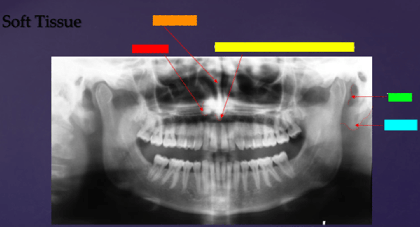 <p>ID the soft tissue anatomy indicated by the arrow pointing from the light blue box:</p>