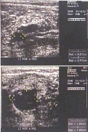 <p>Consider the popliteal artery diameters measured in the images below. is there evidence of a popliteal aneurysm? why or why not?</p>
