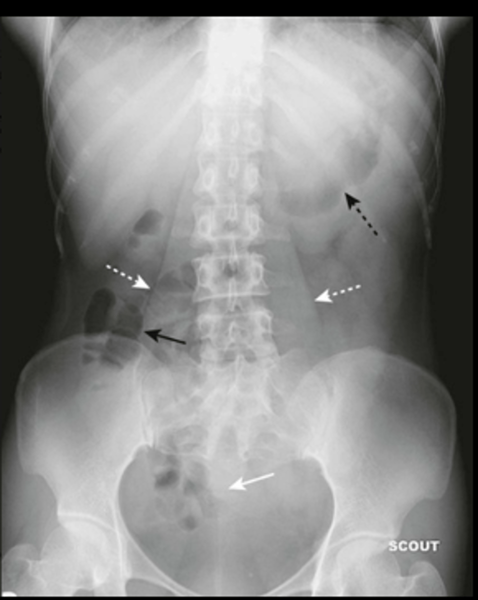 <p>air in stomach, 2-3 loops of air in non-dilated small bowel, air in rectosigmoid, no free air in diaphram, liver displaces gas, no fluid or dilation of colon</p>