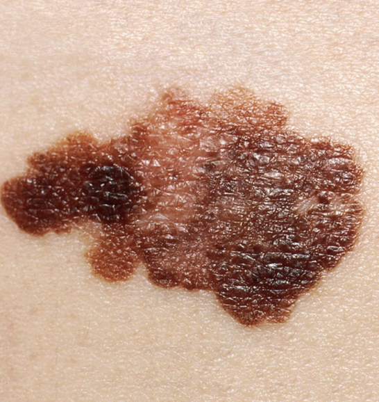 <p>what type of raised, primary skin lesion is this?</p>