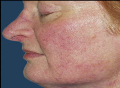 <p>Chronic skin condition of middle age. Skin has blotchy erythema and dilated blood vessels (= rose colored).</p>