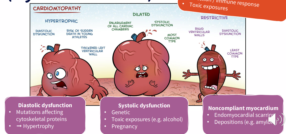 <p>INTRINSIC CARDIOVASCULAR MUSCLE DISEASE:</p><p>- Some aetiologies: idiopathic, genetic, infection/immune response, toxic exposures</p><p>.</p><p>DIASTOLIC DYSFUNCTION:</p><p>- mutations affecting cytoskeletal proteins - hypertrophy</p><p>.</p><p>SYSTOLIC DYSFUNCTION:</p><p>- genetic</p><p>- toxic exposures (e.g alcohol)</p><p>- pregnancy</p><p>.</p><p>NONCOMPLIANT MYOCARDIUM:</p><p>- endomyocardial scarring</p><p>- depositions (e.g amyloid)</p>