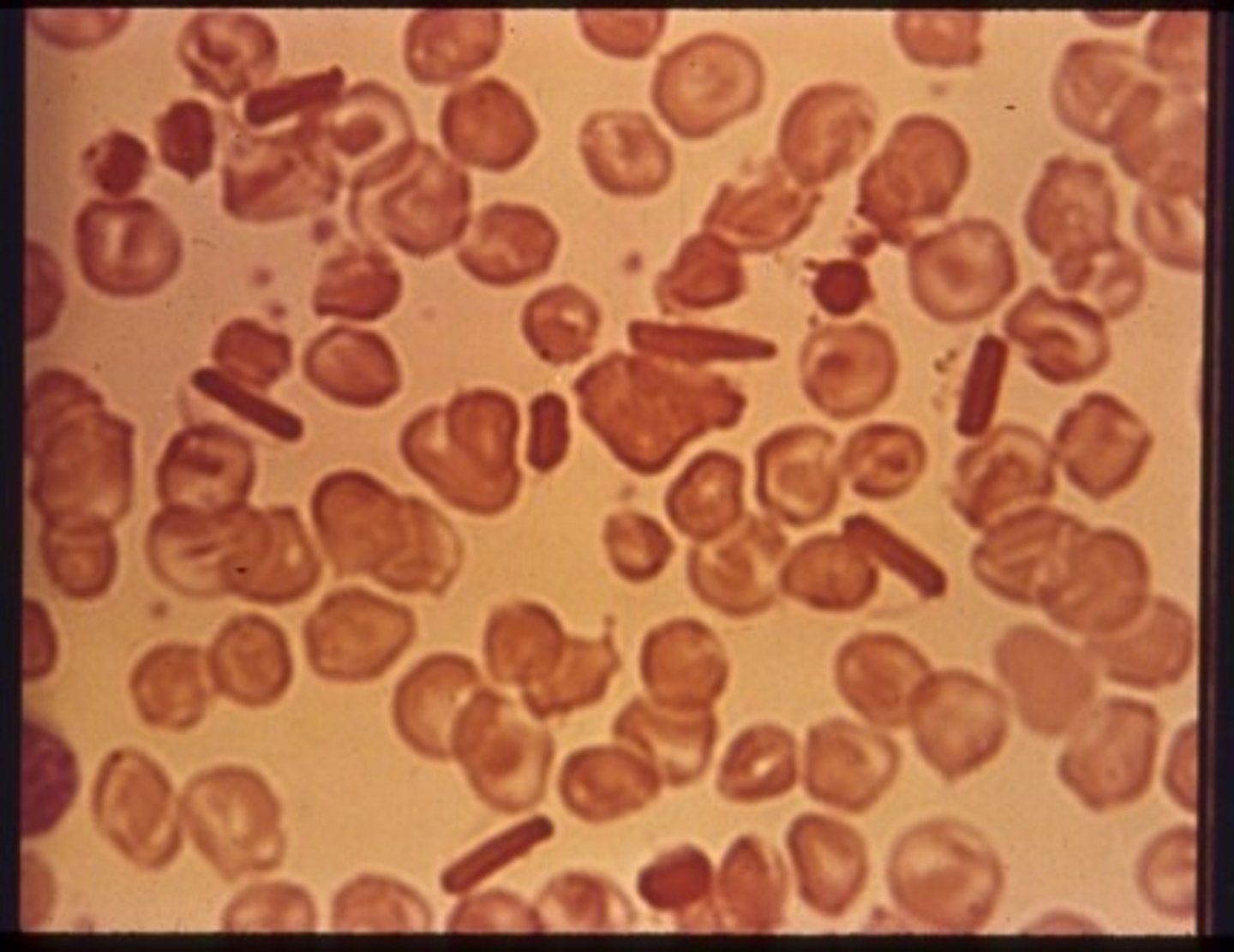<p>-Intracellular red rod-shaped crystals</p><p>- Beta chain mutation -&gt; OxyHbC -&gt; crystals</p><p>*Diagnostic for HbC</p>