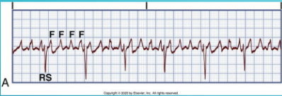 multiple waves prior to a QRS complex. Sawtooth appearance. Onlymeasure QRS.