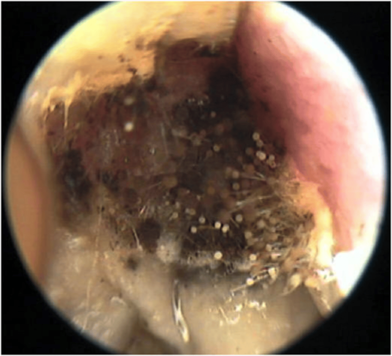 <p>Fungal infection</p><p>White coloured thick debris</p><p>Fluffy appearance (Mycelium growth)</p><p>Underlying skin is red, tender, &amp; swollen</p>