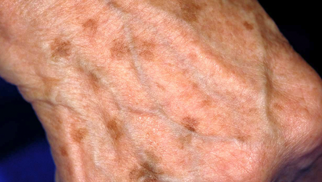 <p>A flat, circumscribed, discoloration on the skin the is LESS than 1 cm </p>