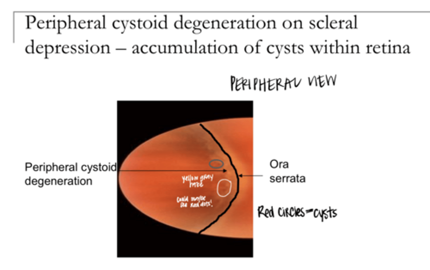 <p>Cystoid Degeneration Pic</p>