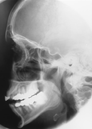<p>What is this x-ray demonstrating?</p>
