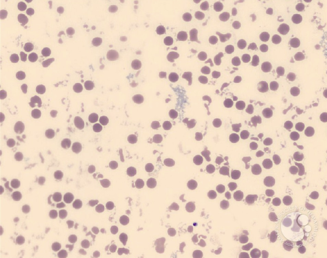<p>what disease/condition is associated with marked anisocytosis/poikilocytosis and increased spherocytes?</p>
