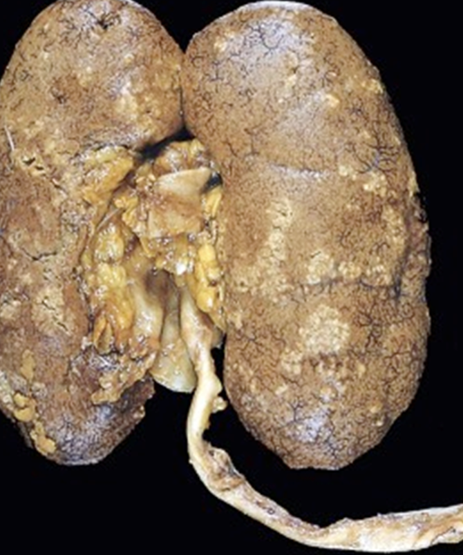 <p>What complication of an acute pyelonephritis is shown?</p>