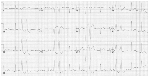 <p>When two PVCs are next to each other, this is called a ____________</p>