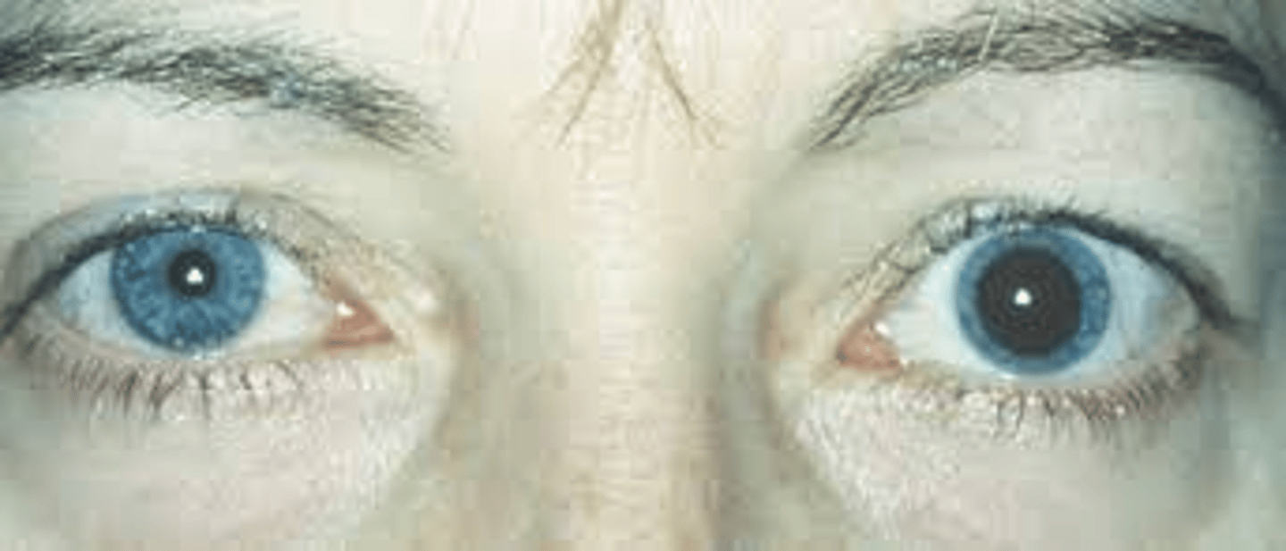 <p>What is suspected if you find your neuro patient with ipsilateral pupil dilation?</p>