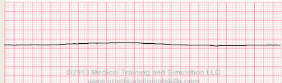 OMG rhythm!

No heart electrical activity or pulse

Heart has stopped – Begin CPR

Patient will NOT be conscious. If talking, check your cables.