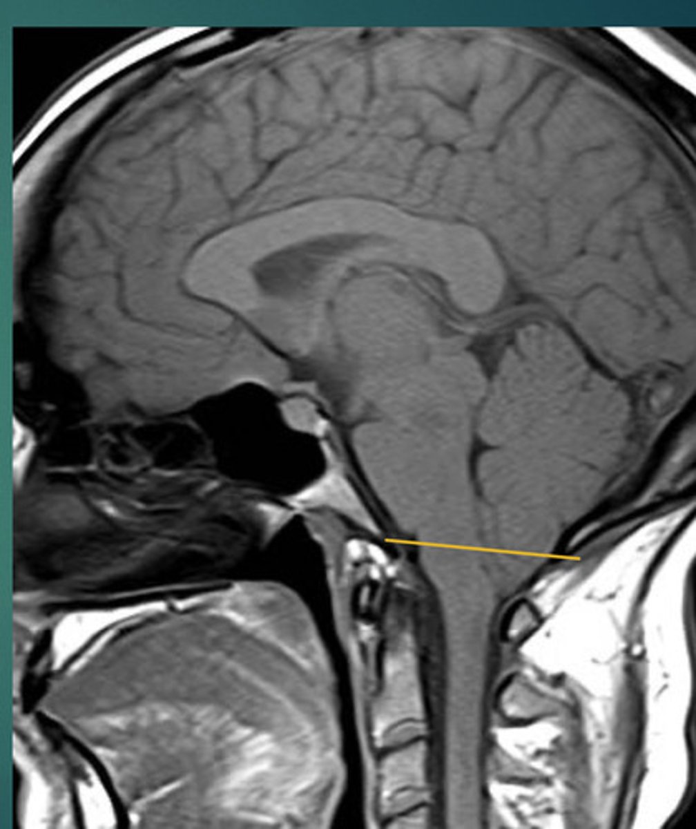 <p>What abnormality is this?</p>