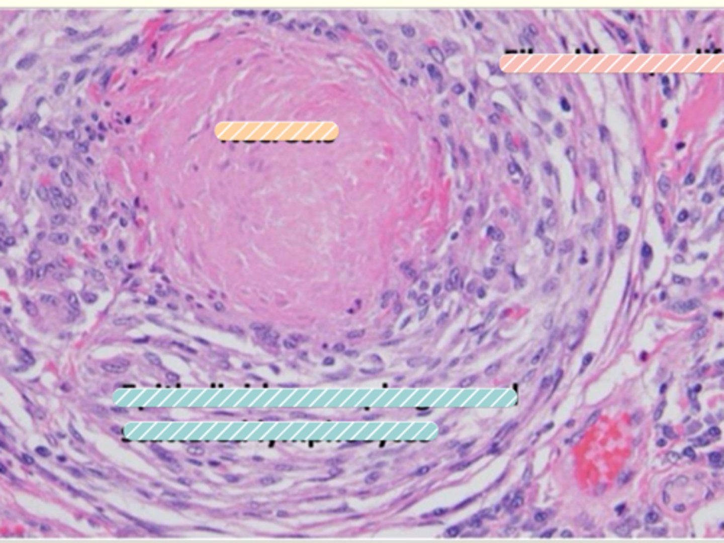 <p>What do we find in the inner most region of a nodular granuloma?</p>