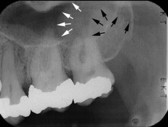 <p>What is the bony landmark indicated by the black arrows?</p>