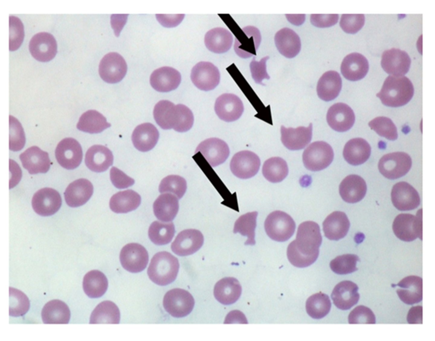 <p>or schistocytes (black arrow), are framented red blood cells. Their presence suggests traumatic microangiopathic hemolytic condition such as DIC, hemolytic uremic syndrome and throbotic thrombocytopenic purpura. Helmet cells are not typically seens in SCD as this hemolysis is intrinsic, not traumatic</p>