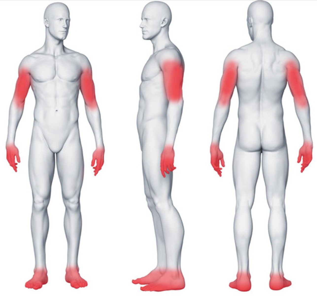 <p>bilateral symptoms, glove and stocking distribution</p><p>- distal symptoms almost always develop first, starting with LE</p>