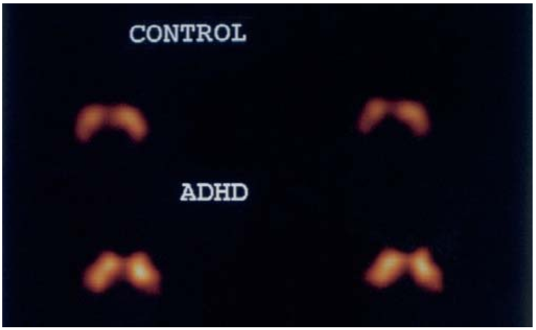 (1231) IPT SPECT images of a drug-naive child with ADHD and a control

