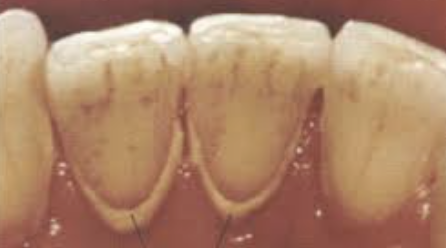 <p>supragingival lingual deposits on CI (clinical considerations)</p>