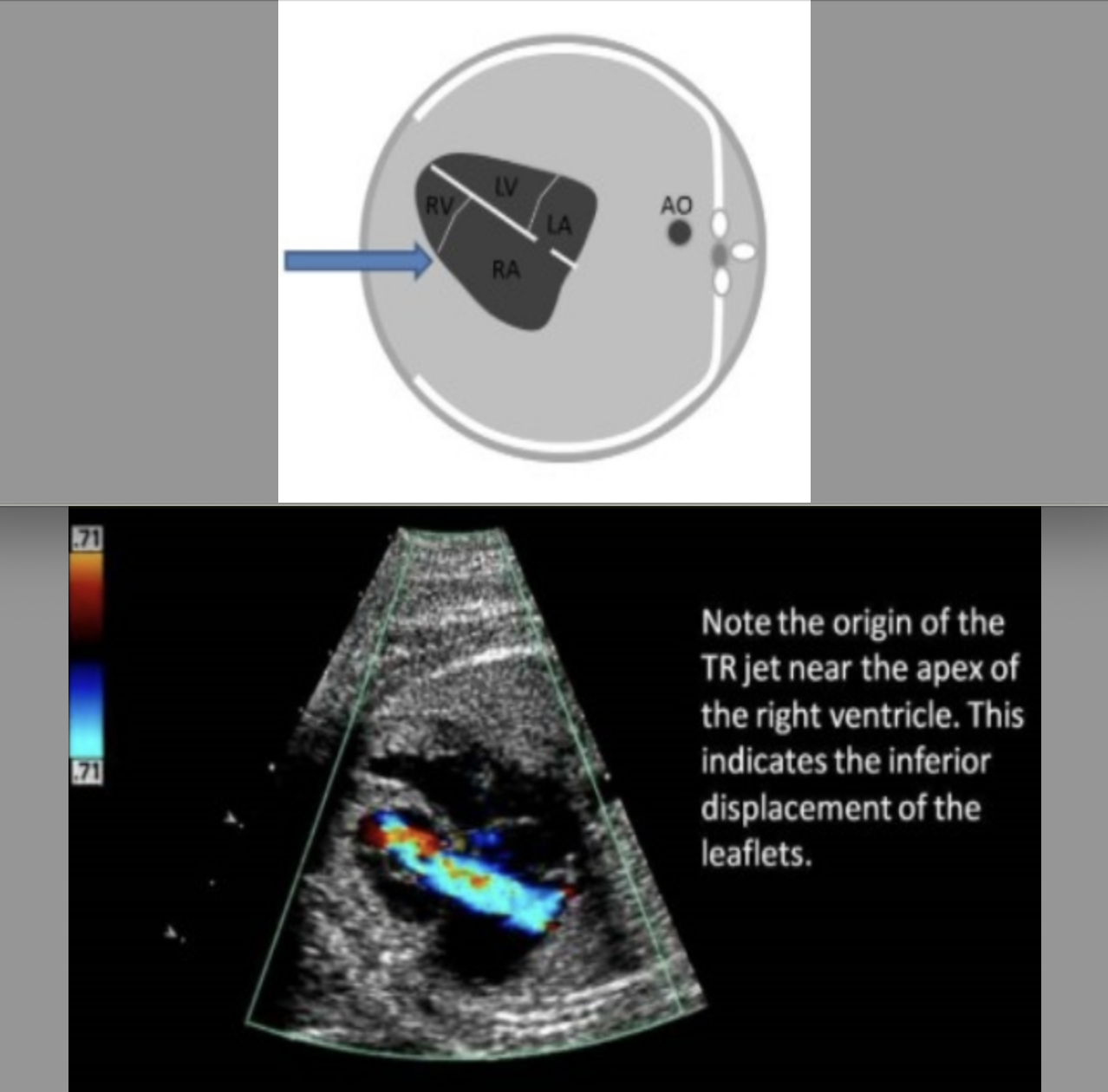 <p><strong>ebstein </strong>anomaly is</p><p>.</p><p>a) abn placement of tricuspid valve more inferiorly into the apex of right ventricle</p><p>b) abn placement of tricuspid valve more inferiorly into the apex of left ventricle</p><p>c) abn placement of the mitral + tricuspid valves more inferiorly into the apex of the ventricles</p><p>d) abn placement of the mitral valve more inferiorly into the apex of left ventricle</p>
