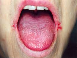 <p>Inflammation of the mouth &amp; tongue; cracks at corner of mouth</p>