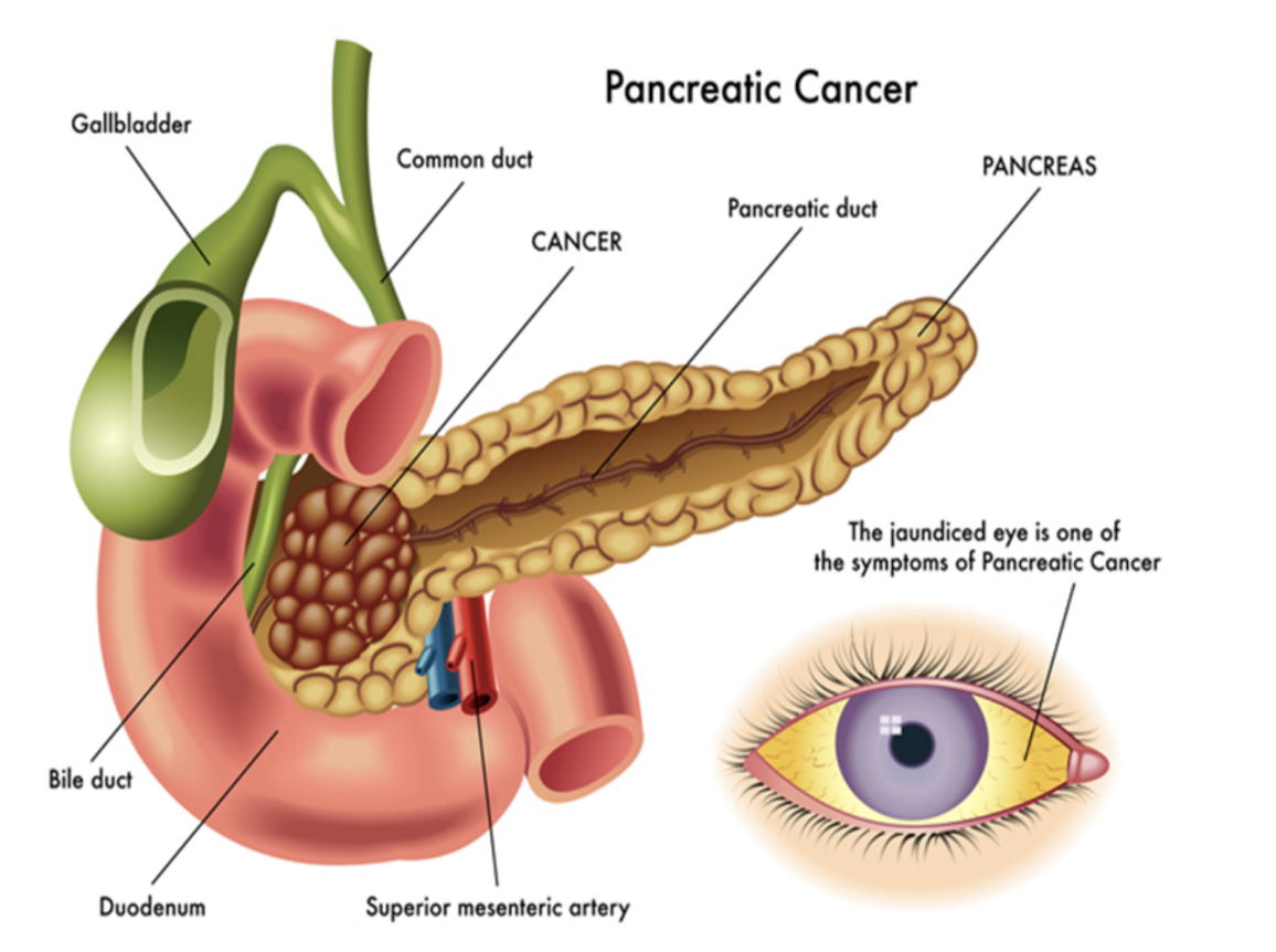 <ul><li><p>Malignant tumors of the pancreas may occur anywhere in the pancreas — but most frequent in head &amp; neck </p></li><li><p>Number of nonspecific findings in patients with pancreatic cancer — </p><ul><li><p>Upper abdominal pain, loss of appetite, &amp; weight loss</p></li></ul></li><li><p>Depending on site of cancer, obstruction of bile duct can occur, leading to obstructive jaundice</p></li><li><p>Most cancers spread locally — invading portal vein &amp; superior mesenteric vessels, even extending into porta hepatis</p><ul><li><p>Lymph node spread is also common, with these factors precluding curative surgery </p></li></ul></li><li><p>Given position of pancreas, a surgical resection is a complex procedure involving resection of the region of the pancreatic tumor usually with part of the duodenum, necessitating a complex bypass procedure </p></li></ul>