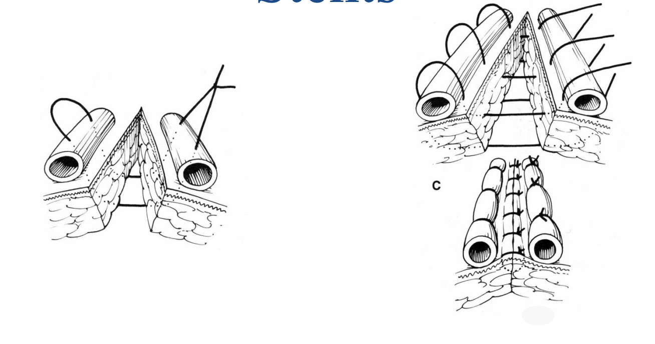 <p>placing padded material beneath the suture loops is stenting</p>