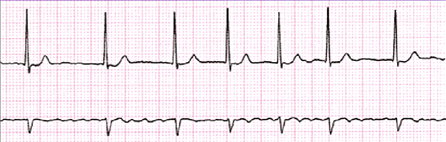 <p>Rate: 120+ BPM<br>Rhythm: Irregular<br>P-Wave: None or Fib Wave<br>PR: None<br>QRS: 0.06-0.10</p>
