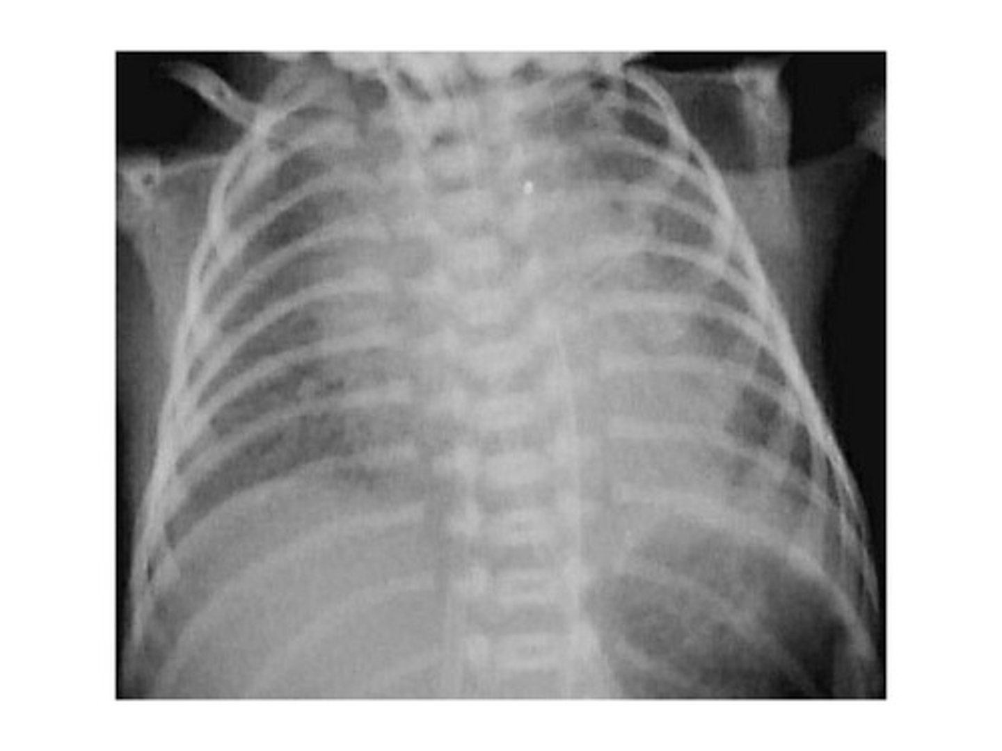 <p>hyaline membrane disease (IRDS)</p>