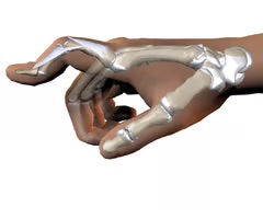 <p><span>-DIP is hyperextended, PIP is flexed</span><br><span>-circumferential PIP joint orthosis should be worn continuously for 6 weeks, prevents flexion deformity</span></p>