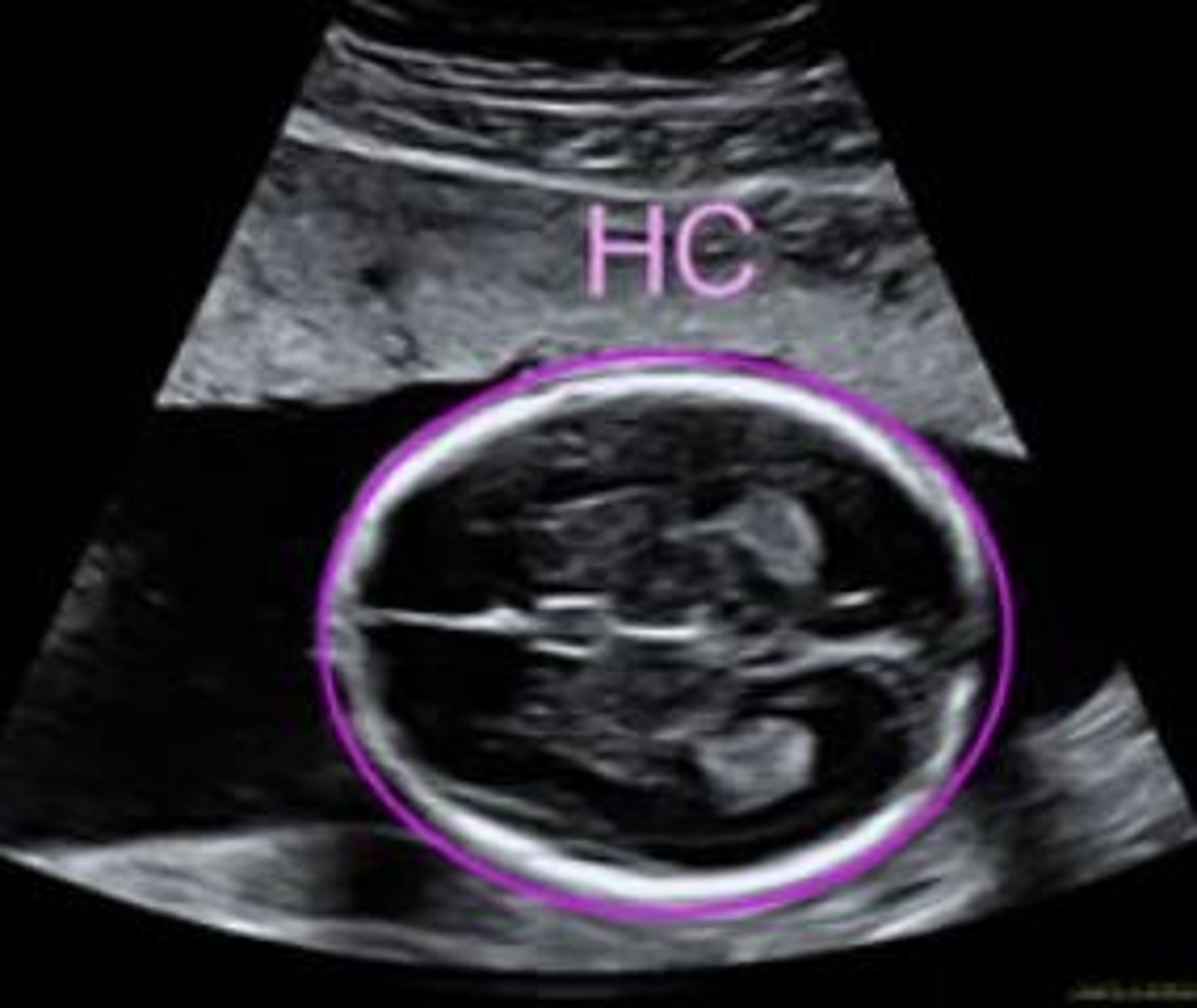 <p>- Head circumference</p><p>- Abdominal circumference</p><p>- Femur length</p>