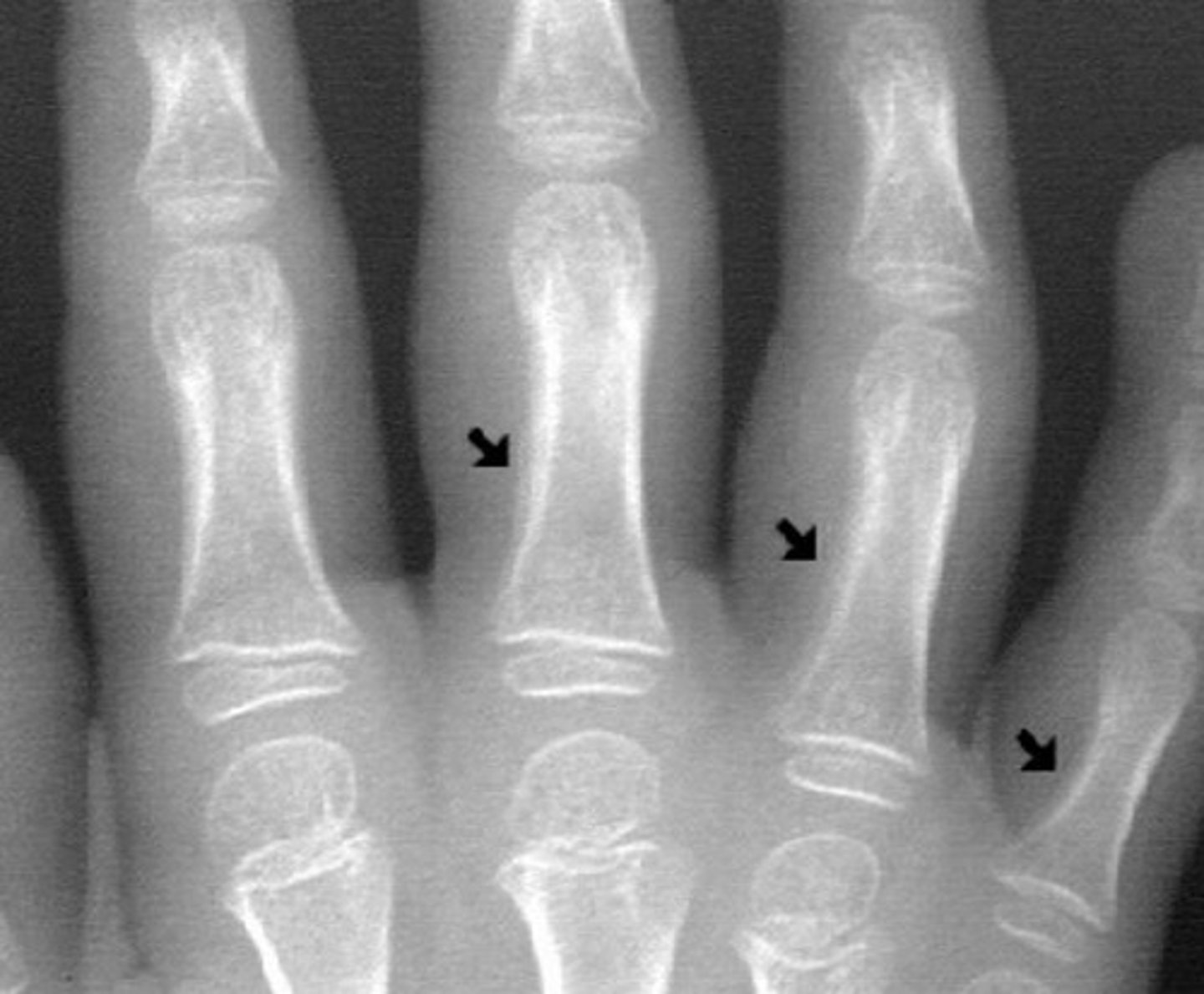 <p>What is called when children have loosely attached</p><p>periosteum which reacts to the hyperemia by lifting</p><p>away from the parent bone?</p><p>What condition is is asssocatied with?</p>