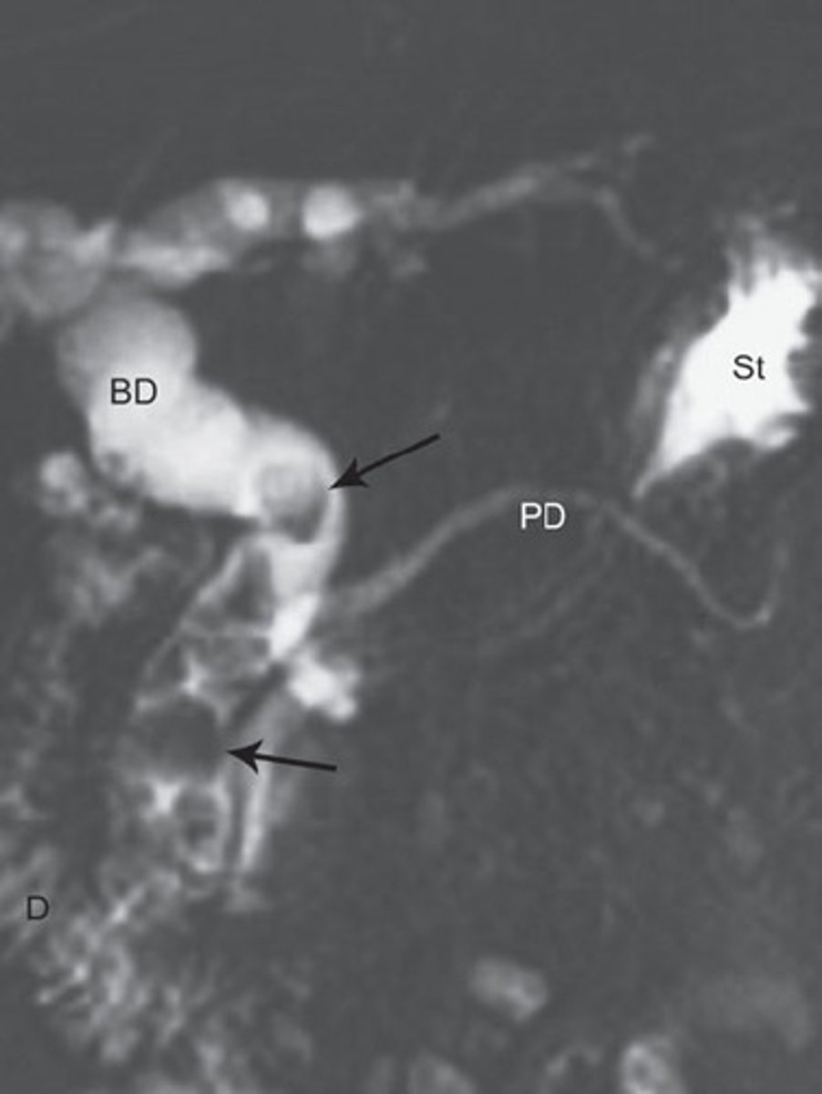 <p>Define Cholelithiasis Complication:</p><p>Common bile duct (CBD) stone causing biliary obstruction</p><p>-Hx: Cholelithiasis</p><p>-Path: Increased ALP --&gt; Increased AST/ALT</p><p>-Sx/PE: Obstructive Jaundice (d/t Increased ALP/GGT +/- Increased CB)</p><p>-Prog: Cholangitis</p>