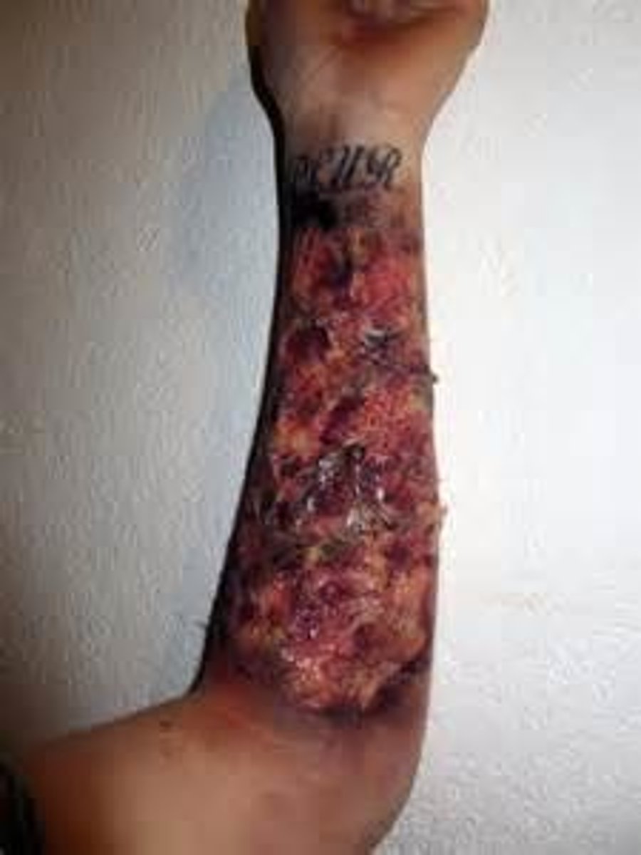 <p>-Entire thickness of skin destroyed, into subcutaneous tissue</p><p>-Black, red, yellow, brown, white</p><p>-Severe edema</p><p>-NO blisters</p><p>-NO pain</p><p>-Eschar hard and inelastic</p><p>-Healing time weeks to months</p>