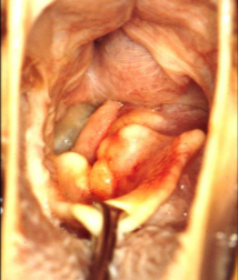 <p><span>Laryngeal Neoplasia</span></p>