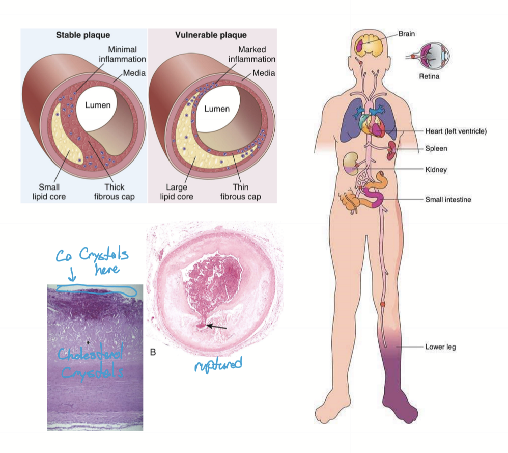 <p>A systemic vascular disease at bends due to endothelial stress.</p>