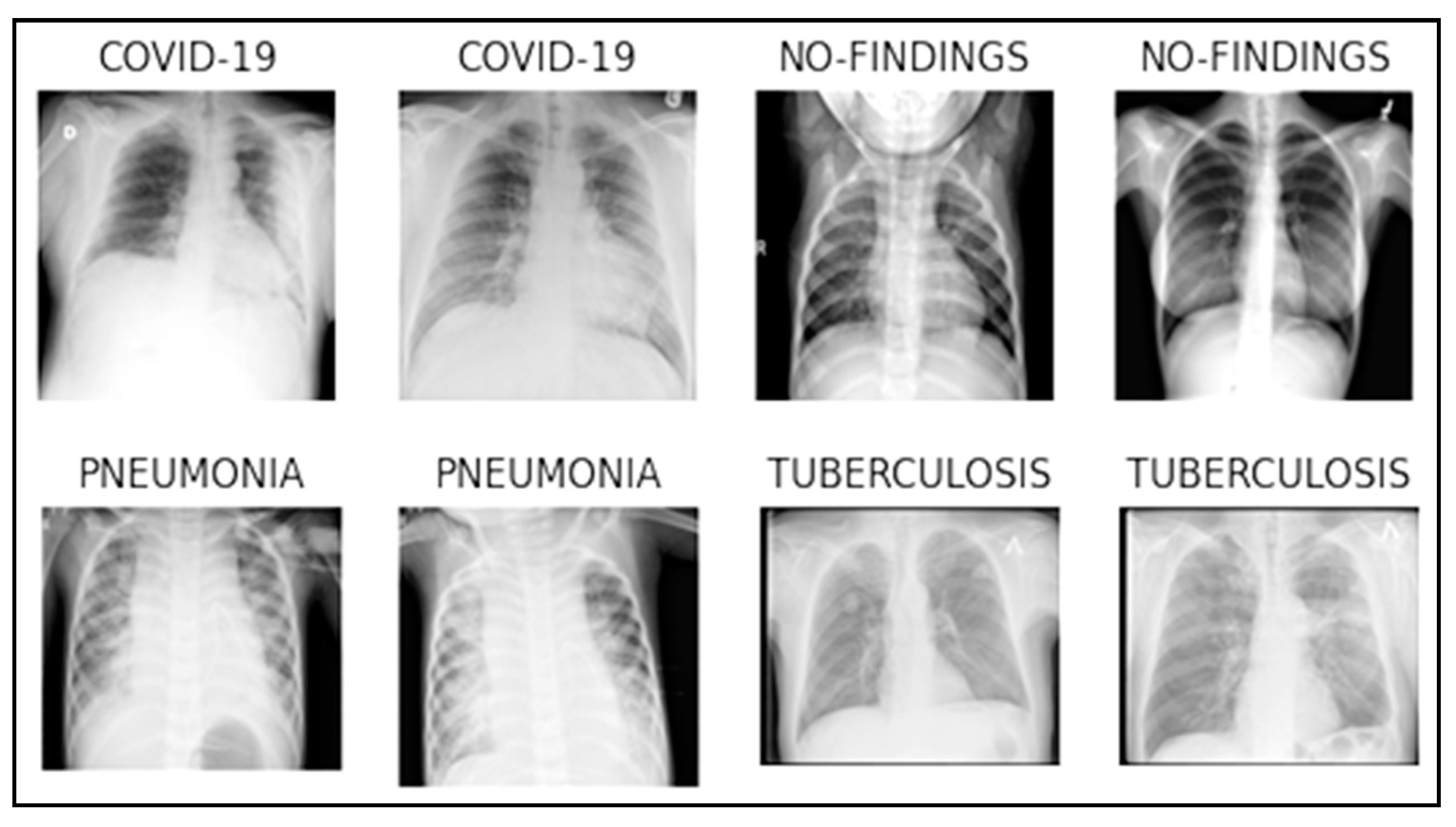 <p>tuberculosis </p>