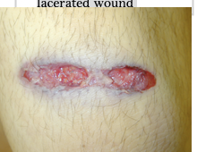 <ul><li><p>from less than 0.5 meters to several kilometers away</p></li><li><p>abrasion collar around entry wound</p></li><li><p>wound is inverted</p></li><li><p>ring of dirt or grease ring</p></li><li><p>bullet striking sideways – may produce rectangular lacerated wound&nbsp;</p></li></ul><p></p>