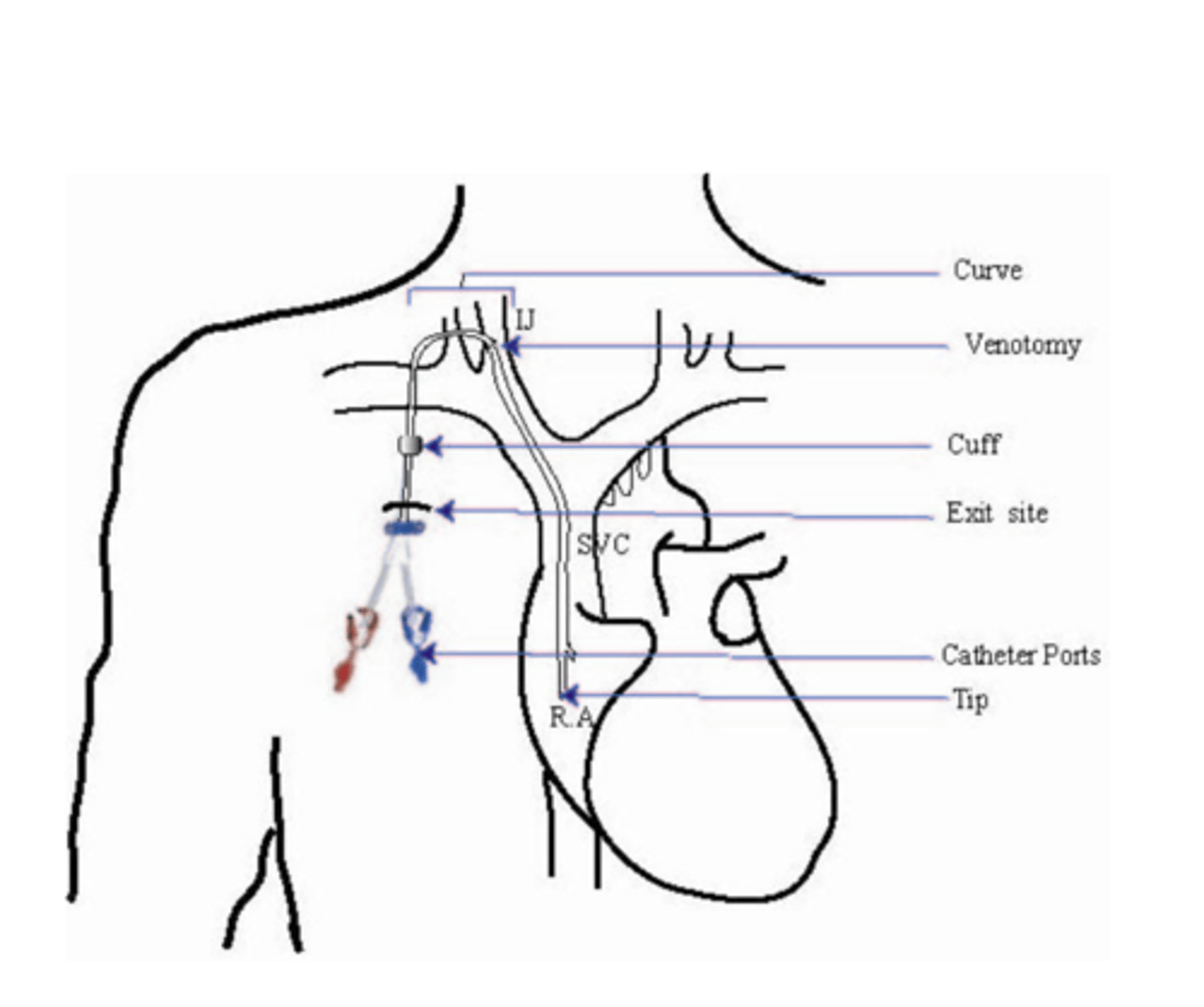 <p>direct access to heart "central line"</p>