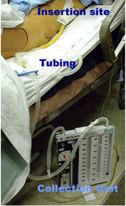 <p><span style="color: blue"><strong>closed, active drain</strong></span><strong>, creates negative pressure to allow reexpansion of the lung, drain, seal and apply suction to pleura-evac-system </strong><br>-drains fluid/blood/air/purulence from intrathoracic space</p><p><em>Removal</em>: when <strong>output &lt;2mL/kg/day, need CXR 1-3 hours on ventilated patient</strong></p><p><em>contraindications: </em>overlying infection, pulmonary adhesions, diaphragmatic hernias, coagulopathies, anticoagulation meds</p><p><em>placed between 4th or 5th intercostal space at mid-axillary line (over 5th or 6th rib); </em><strong><em>tip will be in the pleural space</em></strong></p>