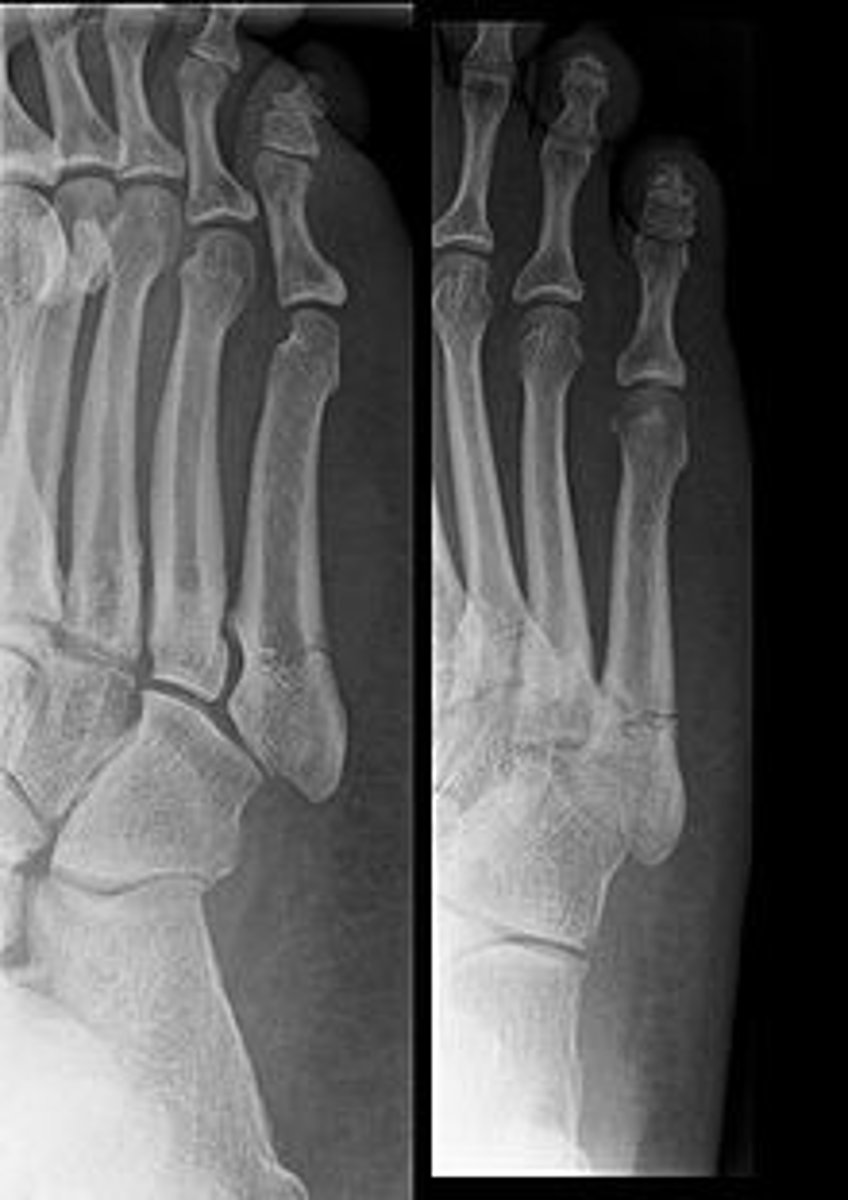 <p>trauma → inversion injury shows up as avulsion fx on XR</p><p>pain and tenderness over base of 5th metatarsal</p>
