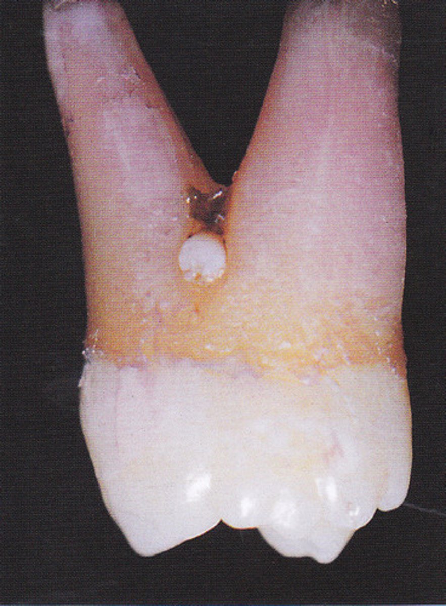 <p>Disturbance of enamel formation during development</p><p>Usually presents in bifurcations or trifurcations</p>