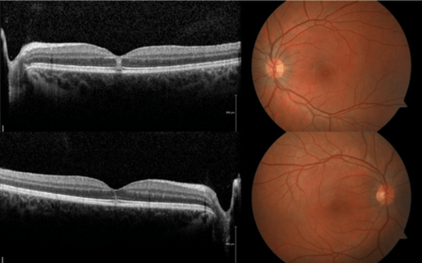 <p>hyperR of outer retinal layers at fovea (acute)</p><p>outer retina/subfoveal PIL disruption</p><p>100-200 micron lamellar hole</p>